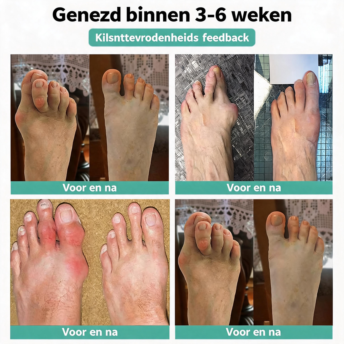 🏅Natravor® Relief Botanical Bunion Comfort Patcht👠💃（Physical Stretch Support + Botanical Comfort Formula)c