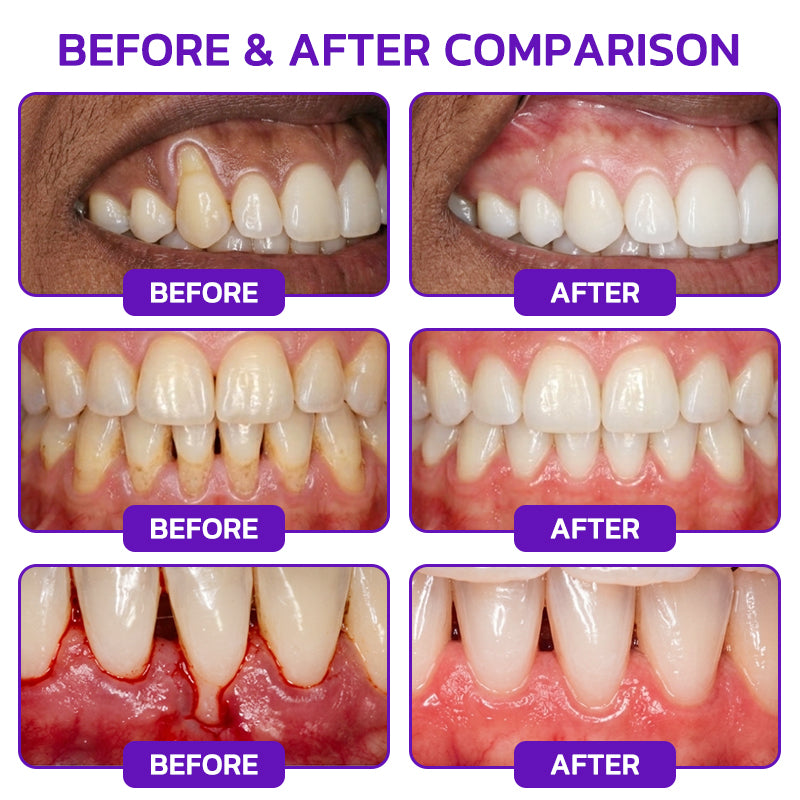 🦷🦷🦷𝐍𝐚𝐭𝐫𝐚𝐯𝐨𝐫® VioCore Bee Venom Gingivitis & Periodontitis Treatment Toothpaste