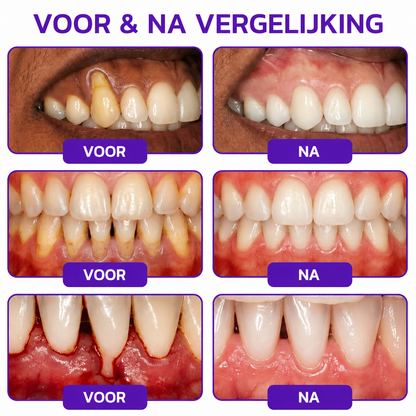 🦷🦷🦷𝐍𝐚𝐭𝐫𝐚𝐯𝐨𝐫® VioCore Bee Venom Gingivitis & Periodontitis Treatment Toothpaste