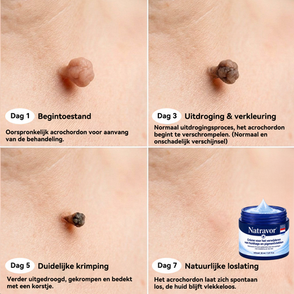 🍇Natravor® Geavanceerde Corrigerende Crème voor Huidflapjes, Moedervlekken & Vlekken – 7 Dagen Zonder Pijn & Zonder Littekens – Geavanceerde Verzorging voor Huidoneffenheden