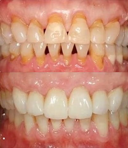 🦷🦷🦷𝐍𝐚𝐭𝐫𝐚𝐯𝐨𝐫® VioCore Bee Venom Gingivitis & Periodontitis Treatment Toothpaste