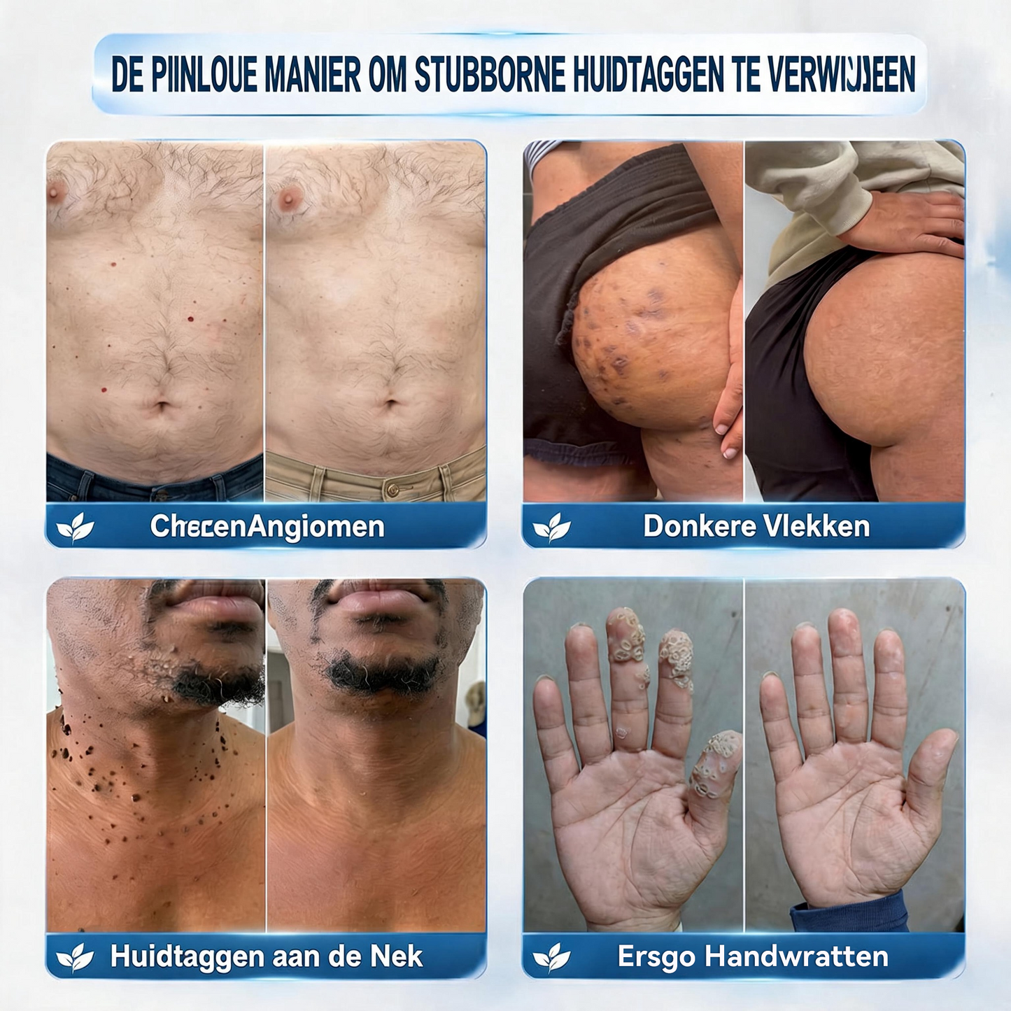🍇Natravor® Geavanceerde Corrigerende Crème voor Huidflapjes, Moedervlekken & Vlekken – 7 Dagen Zonder Pijn & Zonder Littekens – Geavanceerde Verzorging voor Huidoneffenheden