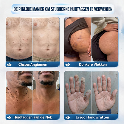 🍇Natravor® Geavanceerde Corrigerende Crème voor Huidflapjes, Moedervlekken & Vlekken – 7 Dagen Zonder Pijn & Zonder Littekens – Geavanceerde Verzorging voor Huidoneffenheden