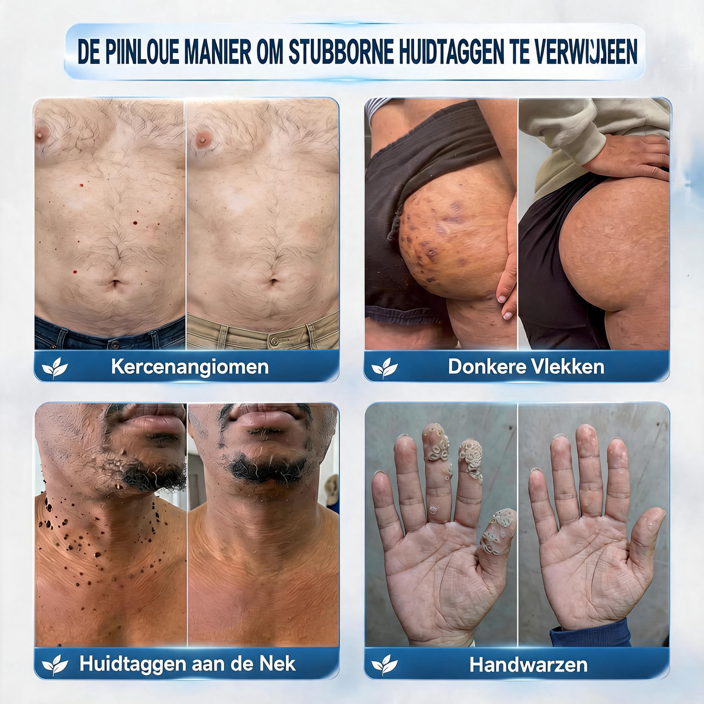 👩‍⚕️Officiële merkshop | ✅️🎉Natravor® 7-daagse wratten- en vlekkenverwijderaar (pijnstillende applicator voor nauwkeurig aanbrengen, laat geen littekens achter)