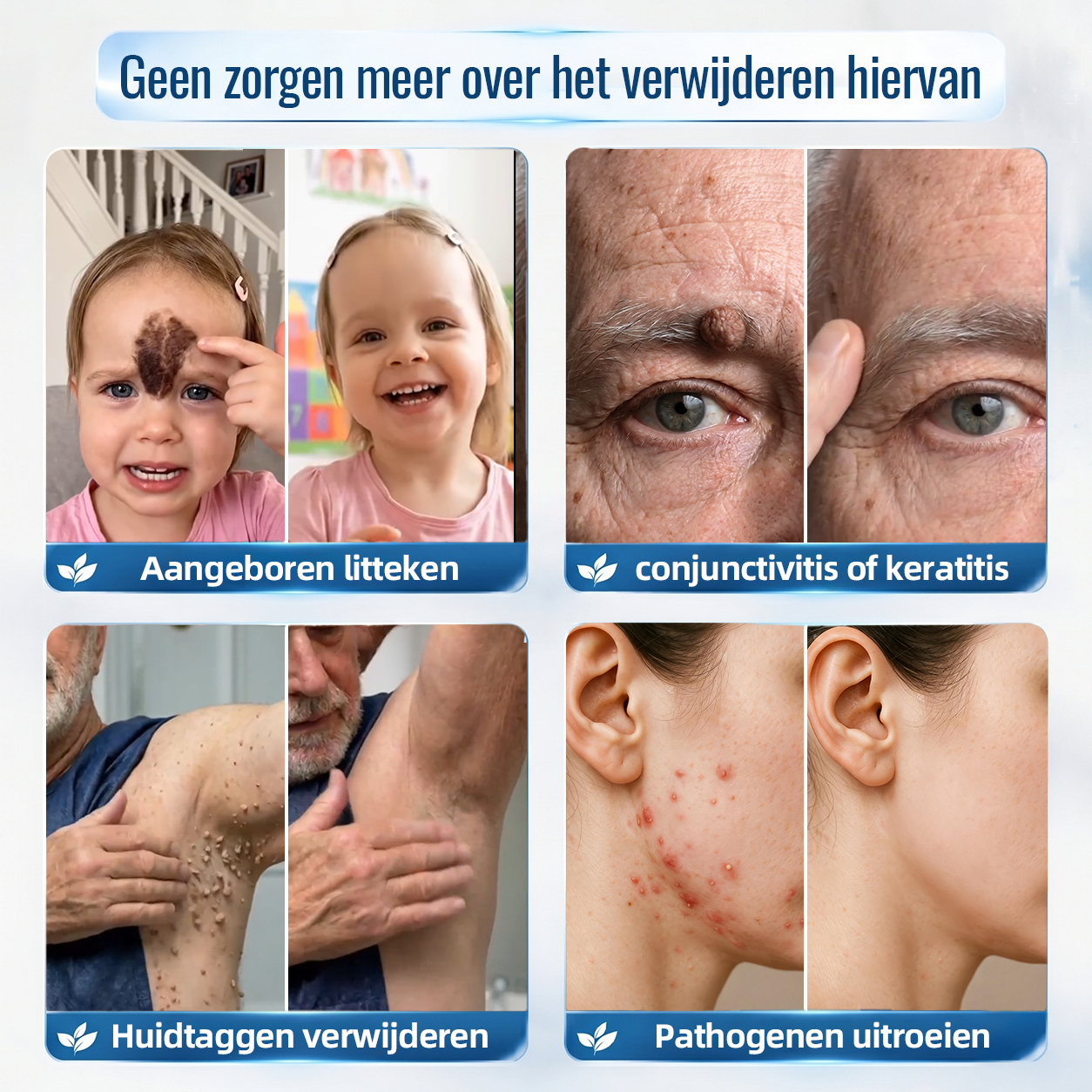 🍇Natravor® Geavanceerde Corrigerende Crème voor Huidflapjes, Moedervlekken & Vlekken – 7 Dagen Zonder Pijn & Zonder Littekens – Geavanceerde Verzorging voor Huidoneffenheden