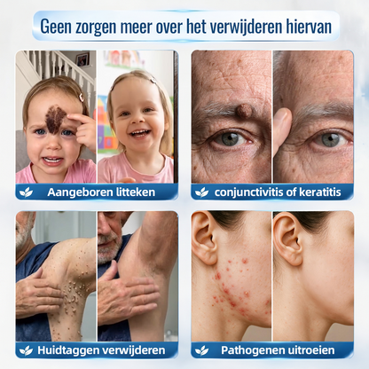 🍇Natravor® Geavanceerde Corrigerende Crème voor Huidflapjes, Moedervlekken & Vlekken – 7 Dagen Zonder Pijn & Zonder Littekens – Geavanceerde Verzorging voor Huidoneffenheden