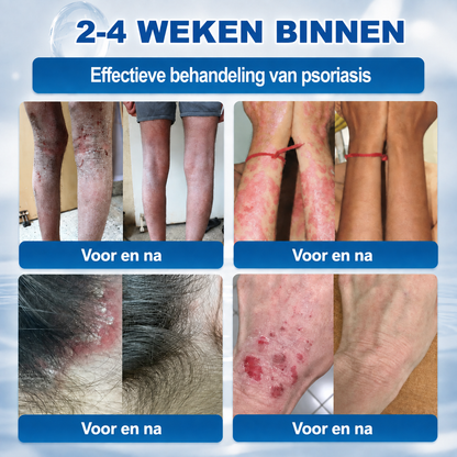 🍇Natravor® Geavanceerde Corrigerende Crème voor Huidflapjes, Moedervlekken & Vlekken – 7 Dagen Zonder Pijn & Zonder Littekens – Geavanceerde Verzorging voor Huidoneffenheden